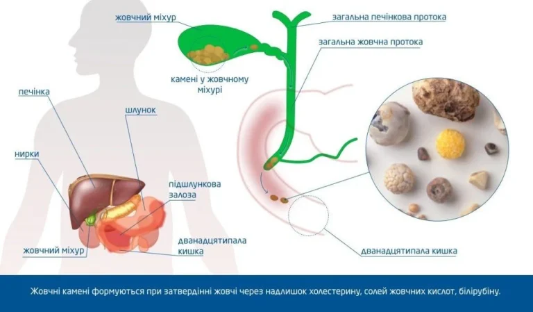Які продукти розчиняють камені в жовчному міхурі: правда, міфи та реальні можливості